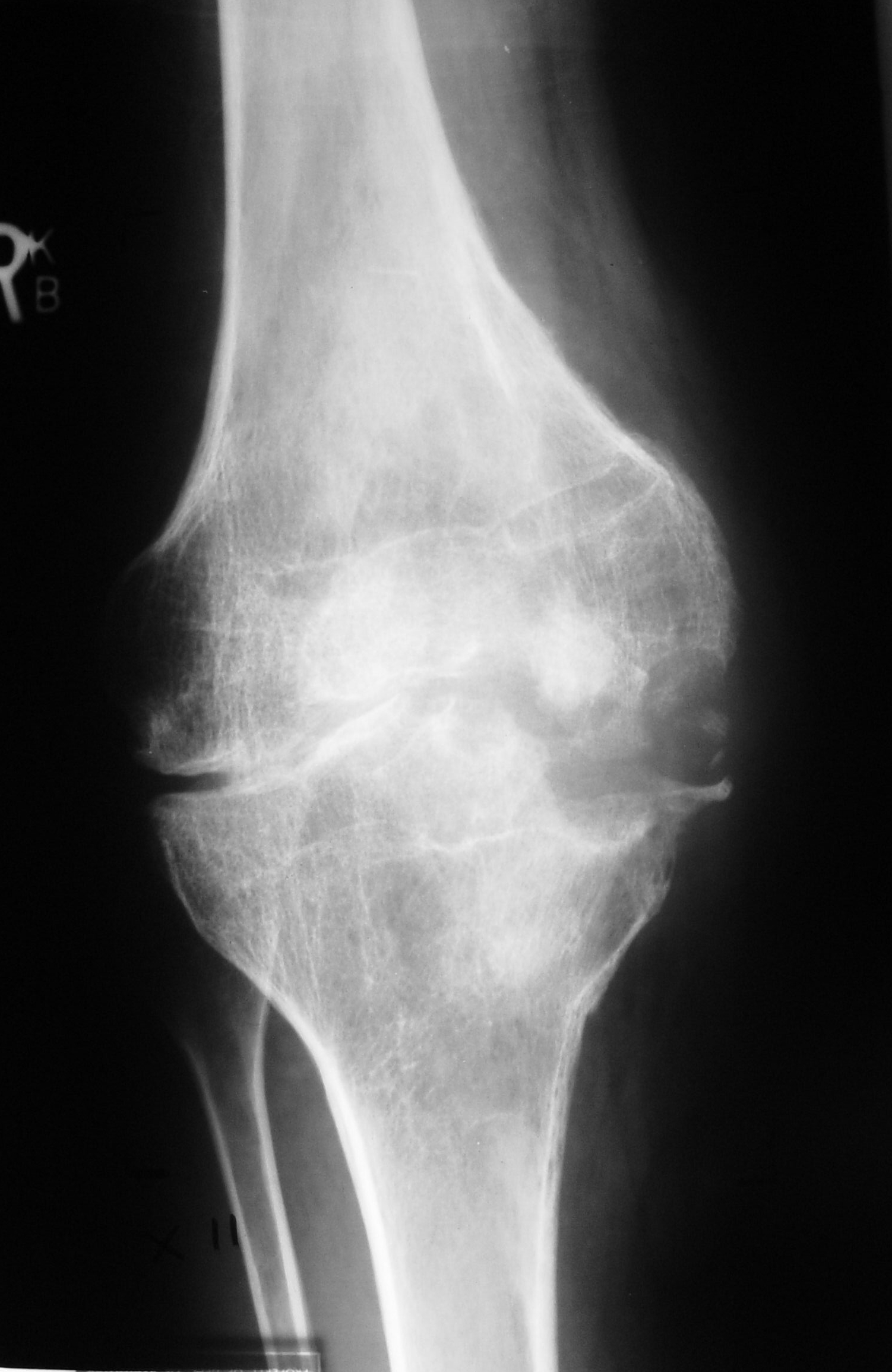 Tuberculosis of knee